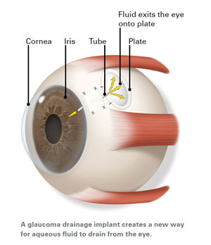 Glaucoma Treatment and surgery